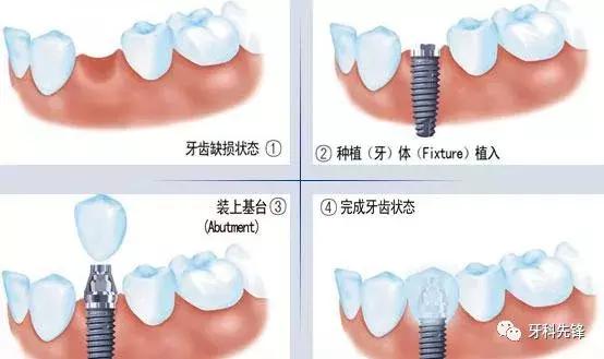 种植牙手术前、中、后应该注意哪些事项？