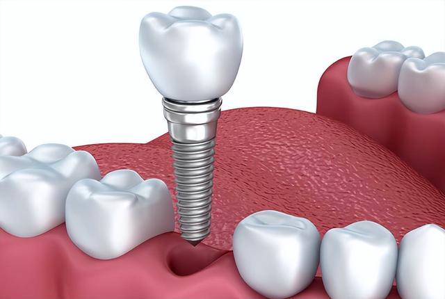 种植牙你该重视的几大选项，不是价格！