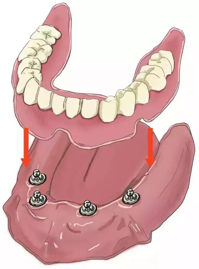 史上最简单明了的种植牙介绍！（图）