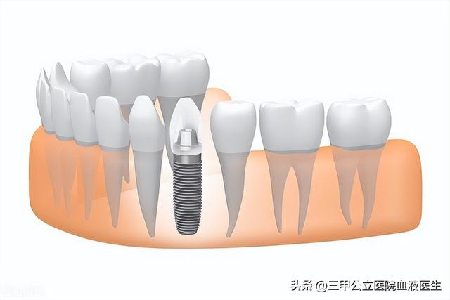 口腔医生绝对不会告诉你种植牙过程中的几点“秘密”