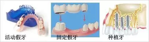 种植牙 VS 镶牙，哪个更胜一筹？