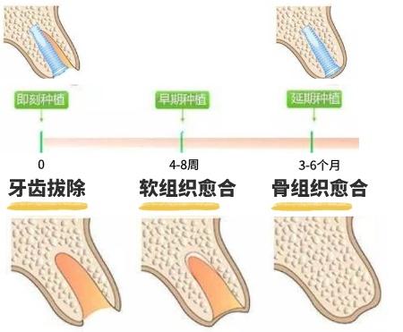 种植牙手术的中的黑科技，即刻种植即刻使用，牙科医生帮你分析