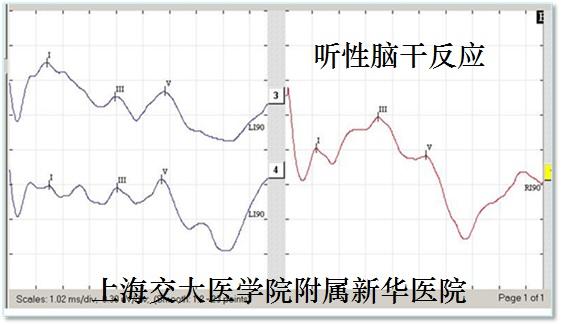 再说小听神经瘤