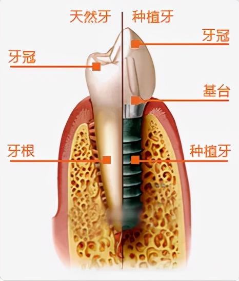 关于种植牙的一些术语，你知道几个？