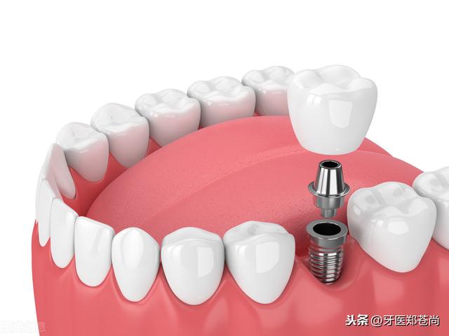 做完种植牙以后，该如何使用、护理？