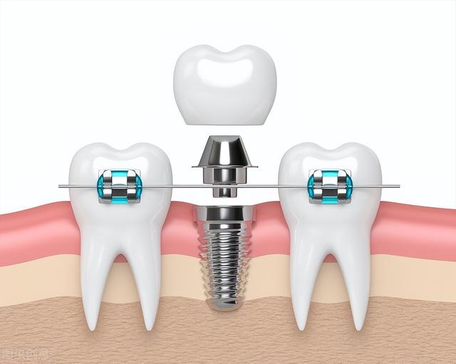 种植牙大揭秘｜牙齿矫正期间能做种植牙手术吗？