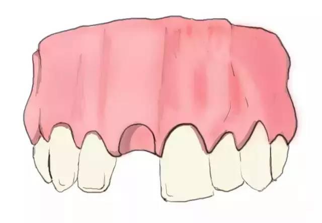 史上最简单明了的种植牙介绍！（图）
