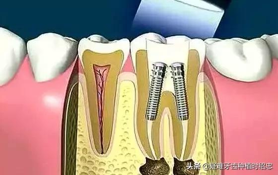 牙齿松动怎么办？这几种治疗方法你要知道！