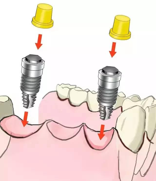 史上最简单明了的种植牙介绍！（图）