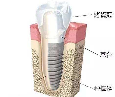 牙齿种植分三期，每次去医院要隔多久？