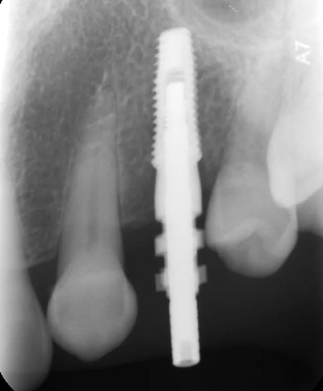 种植牙修复过程中的放射线检查