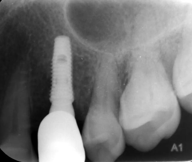 种植牙修复过程中的放射线检查