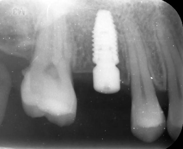 种植牙修复过程中的放射线检查