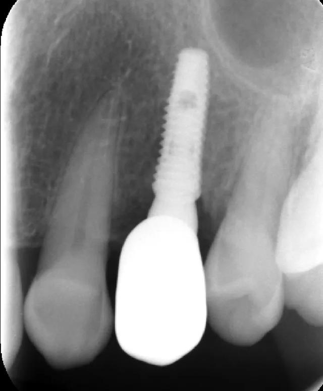 种植牙修复过程中的放射线检查