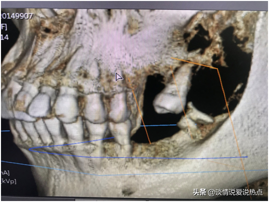 分享我的种植牙经历（全过程），坐标广西南宁