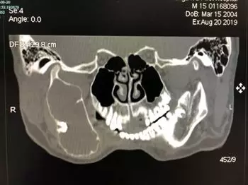 15岁少年牙痛一年多，没想到下颌骨被“吃掉”了一半