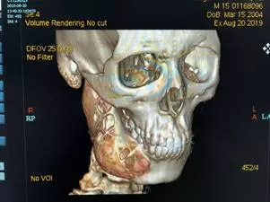 15岁少年牙痛一年多，没想到下颌骨被“吃掉”了一半
