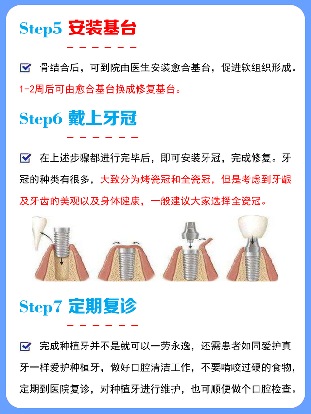 「口腔科普」7个步骤了解种植牙的种植全过程