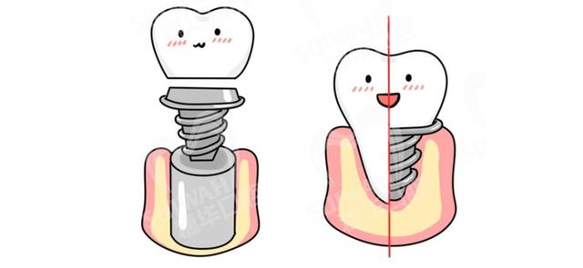 种一颗牙到底贵在哪里？种牙前，医生想告诉你的6件事