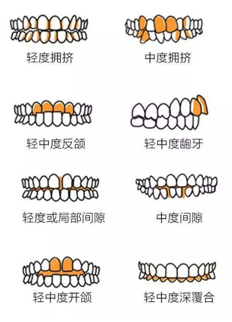 还是淡定点吧，拔牙正畸而已