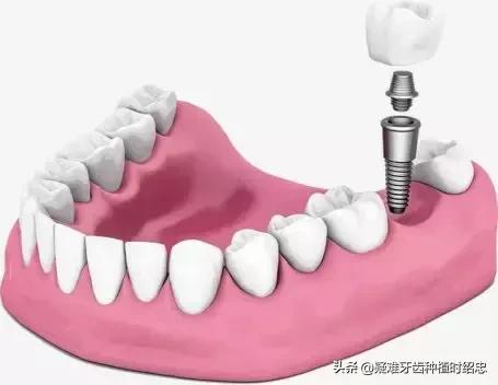 原来老人患有骨质疏松也能种牙？