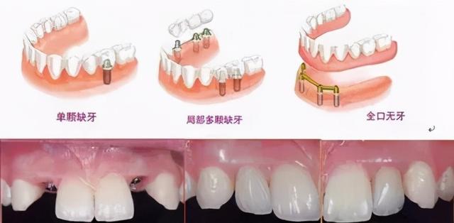 患者在种牙前都会问的“问题汇总”，其中有些“秘密”你需要知道