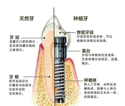 种植牙真的安全吗？价格多少能用多久？为你解密四大种植牙的问题