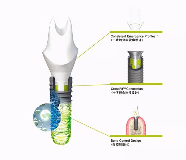 患者在种牙前都会问的“问题汇总”，其中有些“秘密”你需要知道