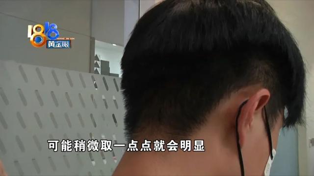 帅气小张“植发”后 左看右看“不如前”