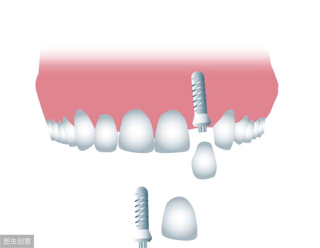 种植牙真的安全吗？价格多少能用多久？为你解密四大种植牙的问题