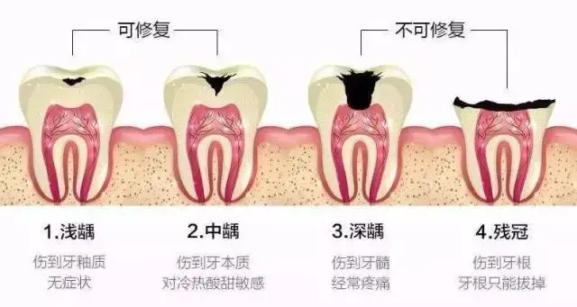 什么是牙齿打桩？什么是根管治疗？这篇建议收藏 #雅悦齿科#