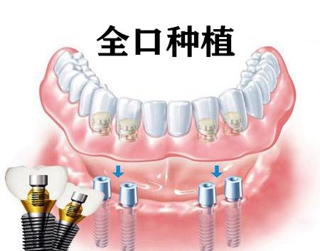 全口牙缺失怎么办？要一颗颗的种吗？资深牙医告诉你怎么做才省钱