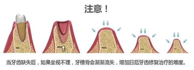 为什么全世界牙医一致推荐种植牙，这才是真正原因