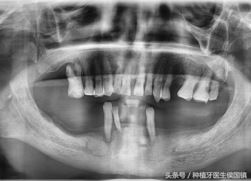 种植牙详细过程是怎么样的？