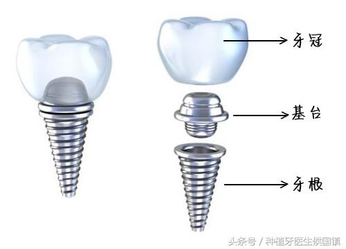 种植牙详细过程是怎么样的？