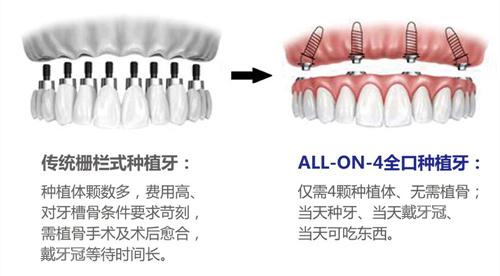 全口牙缺失怎么办？要一颗颗的种吗？资深牙医告诉你怎么做才省钱