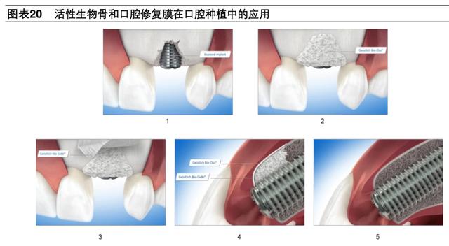 牙科医疗专题报告：种植牙深度研究