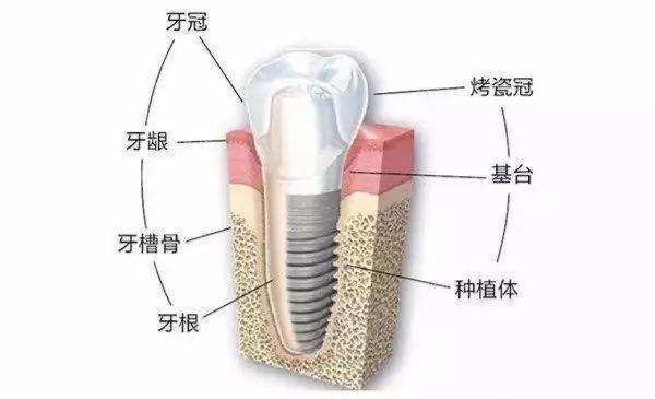 种植牙的详细过程，做种植牙的人最想问的几个问题，牙医为你揭秘