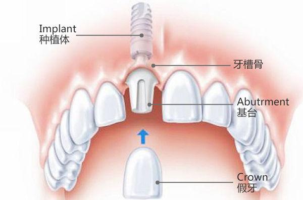 种植牙的详细过程，做种植牙的人最想问的几个问题，牙医为你揭秘