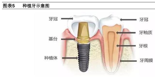 牙科医疗专题报告：种植牙深度研究