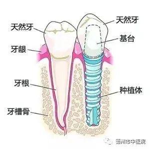 德州市中医院口腔科｜种植牙有6大优点，日常维护这3点务必注意