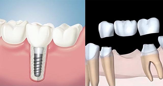 种植牙齿到底好不好呢？