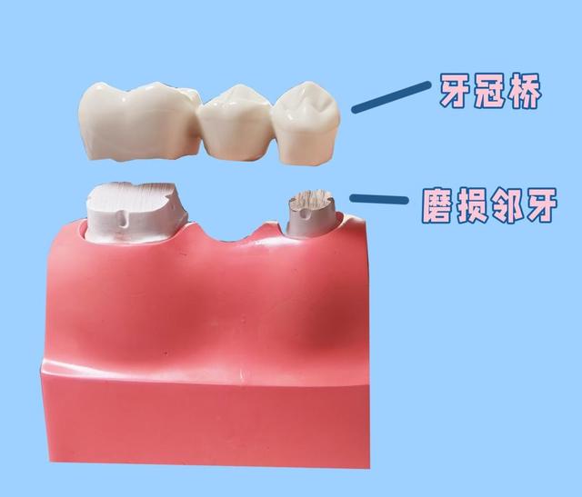 「牙齿那些事儿」No.14丨种植牙就是固定假牙吗？有什么区别