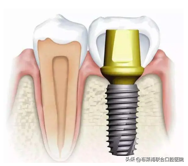 种植牙怎么种进牙龈的？把“螺丝”放进肉里不疼吗？