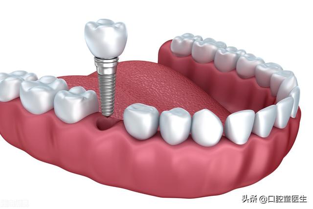 一颗种植牙只需要三千的宣传广告你觉得是真的还是假的？