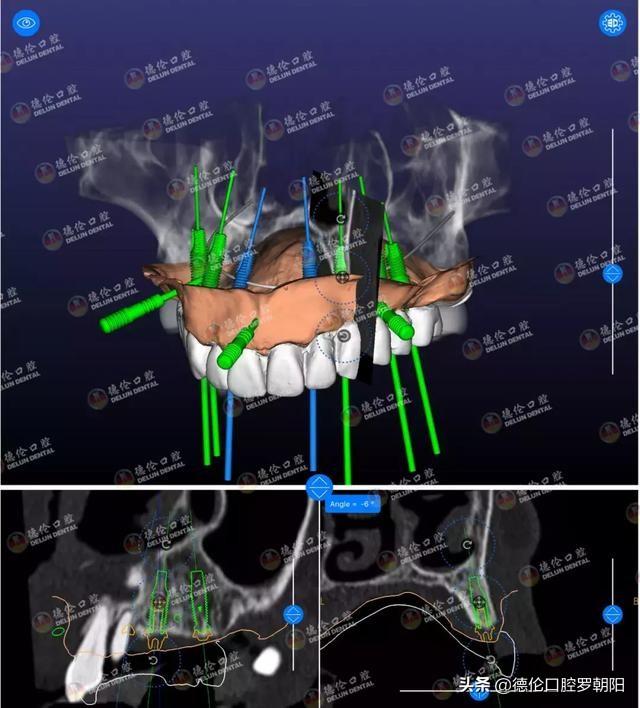 种植牙，就要花钱少、不折腾、使用寿命长