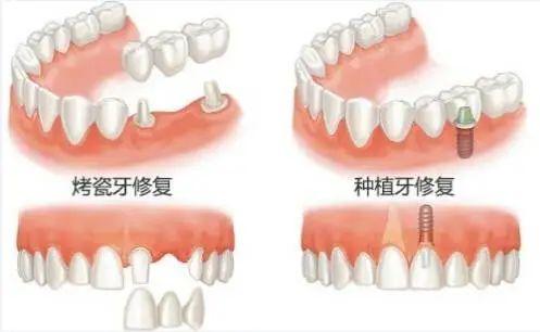 种全口牙相当于县城买套房？3分钟带你明白种植牙全过程