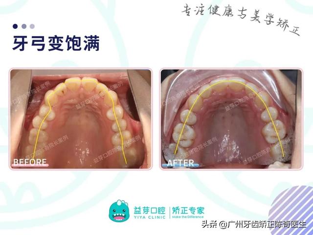 4颗骨钉解决严重骨性前突+露龈笑~别看骨钉小，作用还挺大