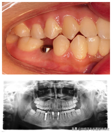 案例分享：后牙拔牙+即刻种植+延期修复