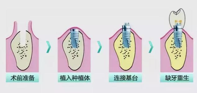 种植牙和烤瓷牙：你更适合哪个？牙科医生告诉你两者的利与弊